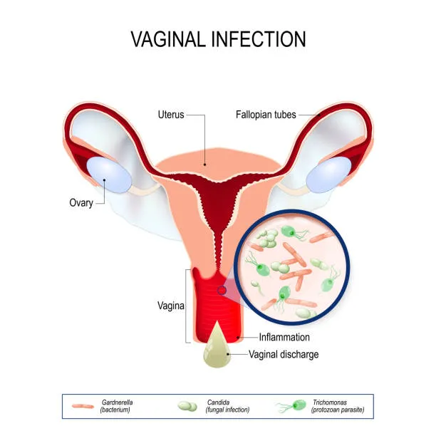What Are Vaginal Infections and Why Should You Get Treated?