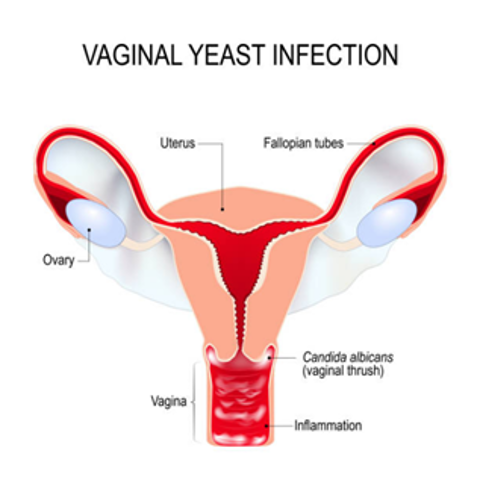 Vaginal Infections Treatment