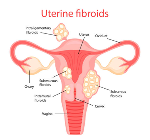 Uterine Fibroids Treatment