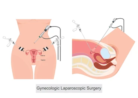 Diagram of gynecologic laparoscopic surgery: abdominal ports with instruments shown on a female pelvis, plus a sagittal cross-section of the pelvis illustrating the uterus and ovaries.