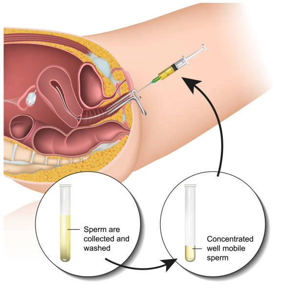 What Are Vaginal Infections and Why Should You Get Treated?