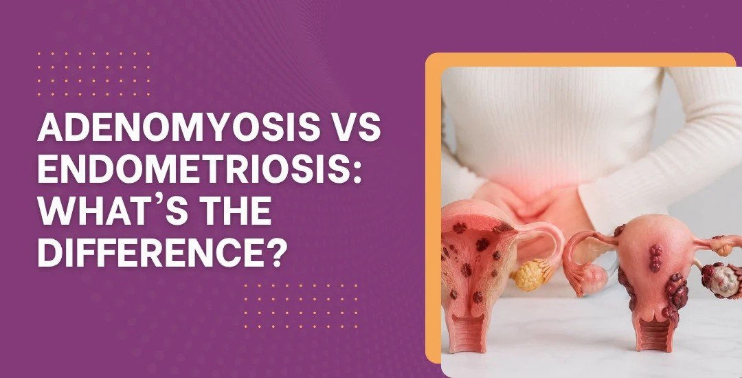 Adenomyosis vs Endometriosis: What's the Difference